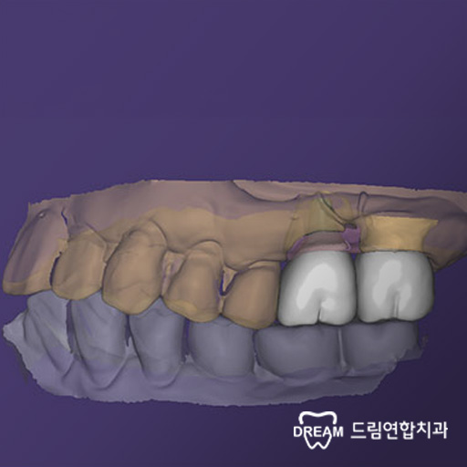 내 치아처럼 편안한 임플란트, 드림연합치과에서 경험하세요.