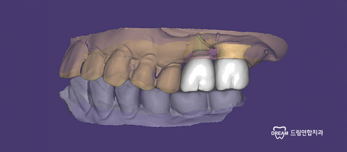 내 치아처럼 편안한 임플란트, 드림연합치과에서 경험하세요. 드림연합치과는 울산 임플란트 센터를 직접 운영하고 있습니다