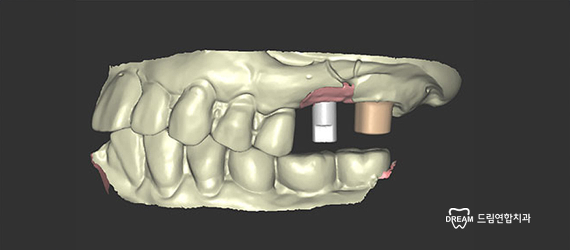내 치아처럼 편안한 임플란트, 드림연합치과에서 경험하세요.