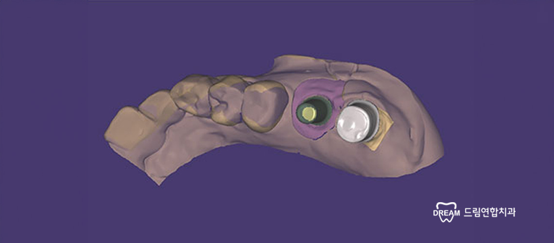 내 치아처럼 편안한 임플란트, 드림연합치과에서 경험하세요.
