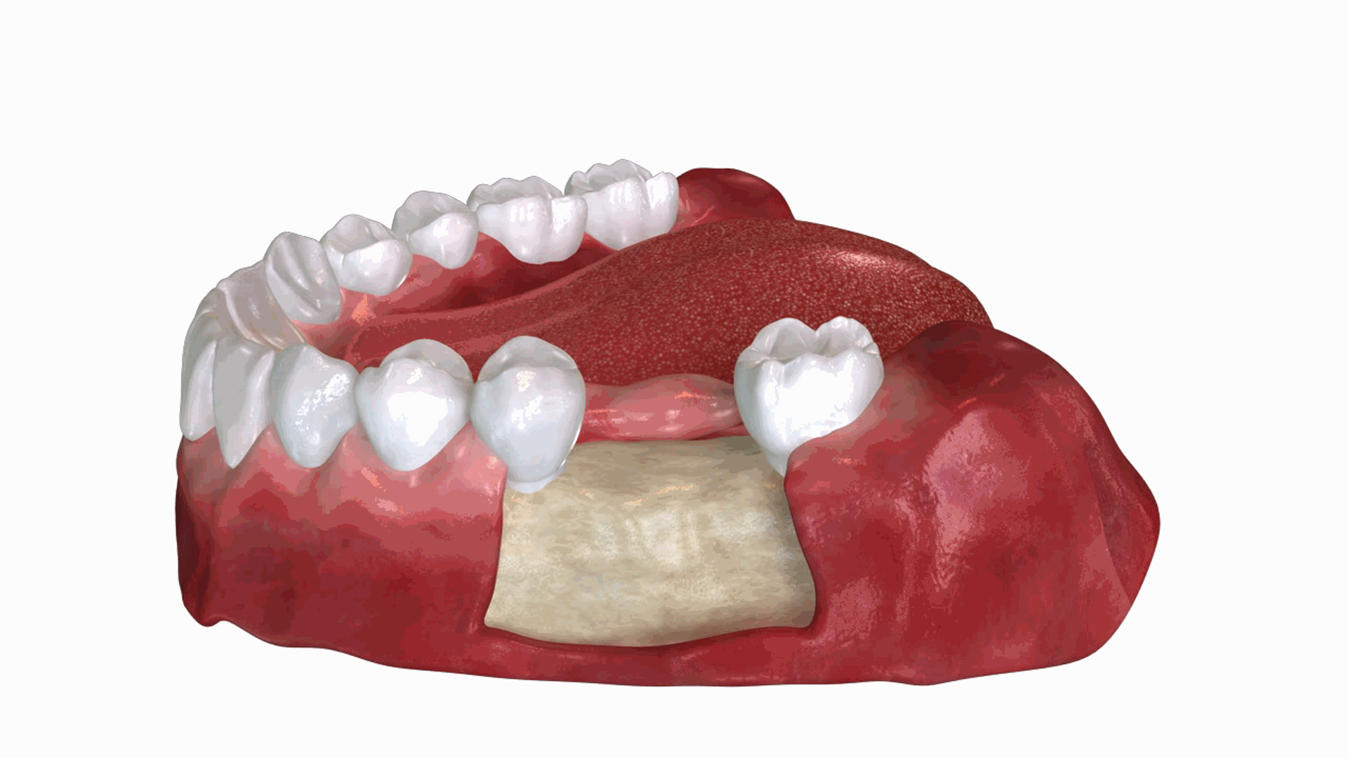 임플란트가 중요한 이유 – 자연치아가 손실되면 턱뼈 손실이 일어난다. 치아가 빠지면 해당 부위의 턱뼈가 자극을 받지 못해 서서히 녹아내립니다. 씹는 압력이 사라지면 뼈 덩어리가 돌이킬 수 없게 줄어듭니다. 이는 얼굴 형태 변화로 이어집니다. 임플란트가 중요한 이유 - 자연치아가 손실되면 턱뼈 손실이 일어난다. 치아가 빠지면 해당 부위의 턱뼈가 자극을 받지 못해 서서히 녹아내립니다. 씹는 압력이 사라지면 뼈 덩어리가 돌이킬 수 없게 줄어듭니다. 이는 얼굴 형태 변화로 이어집니다.