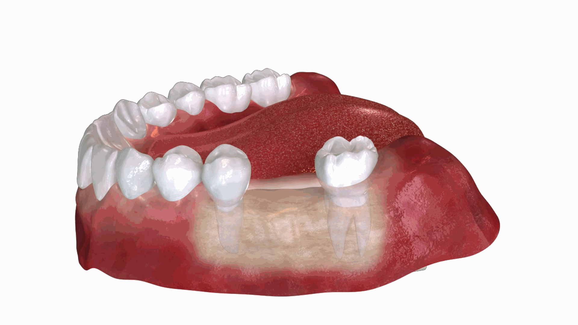 임플란트가 중요한 이유 – 자연치아가 손실되면 주변 치아의 이동한다. 빈 공간으로 인해 주변 치아들이 틈새로 기울어지거나 이동합니다. 시간이 지남에 따라 턱의 다른 부분에 있는 치아 사이에도 틈이 생깁니다. 이는 전체적인 치열과 교합에 영향을 줍니다. 임플란트가 중요한 이유 - 자연치아가 손실되면 턱뼈 손실이 일어난다. 치아가 빠지면 해당 부위의 턱뼈가 자극을 받지 못해 서서히 녹아내립니다. 씹는 압력이 사라지면 뼈 덩어리가 돌이킬 수 없게 줄어듭니다. 이는 얼굴 형태 변화로 이어집니다.