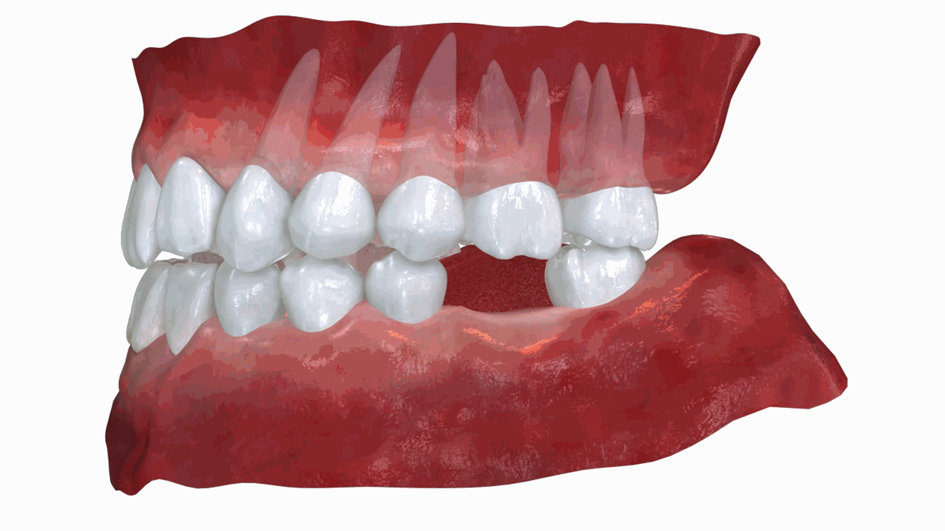 임플란트가 중요한 이유 – 자연치아가 손실되면 반대편 치아의 과도한 맹출이 일어난다. 빈 공간 맞은편의 치아는 “반작용하는 힘”이 없어 빈 공간 쪽으로 돌출됩니다. 이는 치아의 정상적인 해부학적 위치를 변화시킵니다. 임플란트가 중요한 이유 - 자연치아가 손실되면 턱뼈 손실이 일어난다. 치아가 빠지면 해당 부위의 턱뼈가 자극을 받지 못해 서서히 녹아내립니다. 씹는 압력이 사라지면 뼈 덩어리가 돌이킬 수 없게 줄어듭니다. 이는 얼굴 형태 변화로 이어집니다.
