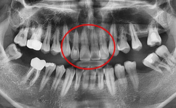 치근단절제술이란? 치근단절제술은 신경치료 후에도 통증이 지속되거나 염증이 재발한 경우, 잇몸을 열고 치아 뿌리 끝을 절제하는 외과적 처치입니다. 이 과정에서 염증을 제거하고 뿌리 끝을 충전하여 치아를 보존합니다. 치료받기 전