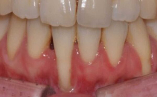 잇몸이식술은 퇴축된 잇몸을 회복시켜 치아 건강과 심미성을 개선하는 첨단 치료법입니다. 드림연합치과는 최신 기술과 풍부한 임상 경험을 바탕으로 높은 성공률의 잇몸이식술을 제공하며 환자 실제 사례로써 치료 전사진