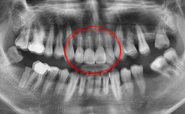 치근단절제술이란? 치근단절제술은 신경치료 후에도 통증이 지속되거나 염증이 재발한 경우, 잇몸을 열고 치아 뿌리 끝을 절제하는 외과적 처치입니다. 이 과정에서 염증을 제거하고 뿌리 끝을 충전하여 치아를 보존합니다. 치료받은 후
