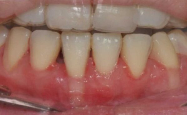 잇몸이식술은 퇴축된 잇몸을 회복시켜 치아 건강과 심미성을 개선하는 첨단 치료법입니다. 드림연합치과는 최신 기술과 풍부한 임상 경험을 바탕으로 높은 성공률의 잇몸이식술을 제공하며 환자 실제 사례로써 치료 후 상태가 회복된 모습