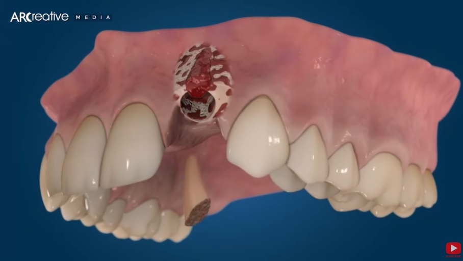 A photograph showing a dentist performing a detailed examination of a patient's mouth using dental instruments to assess an existing implant for revision. Convey trust and precision in clinical style