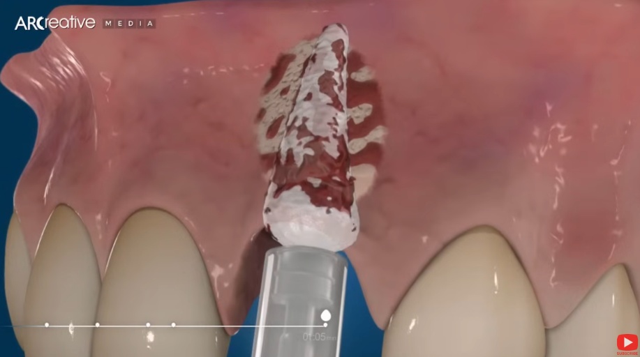 An image showing a 3D CT scan of a jaw with dental implants, highlighting the planning phase for an implant revision. Illustrate the precision of modern dental diagnostics. 3D render in clean style."