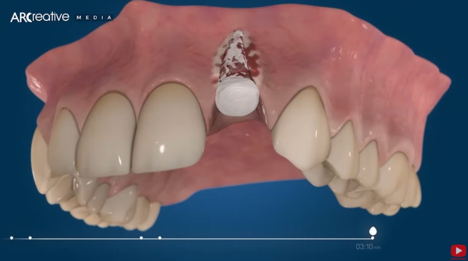 A photo of a dental professional explaining a surgical bone grafting procedure to a patient in preparation for a revised dental implant, use warm and trusting interaction in modern dental clinic. Patient view."