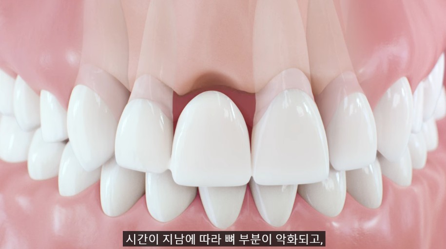 통적인 브릿지는 주변 건강한 치아를 삭제하여 기둥으로 사용