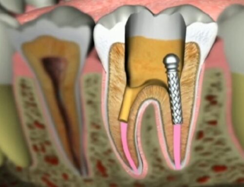 울산 신경치료 재치료 | 치료 후 또 아픈 이유와 해결법 (드림연합치과)