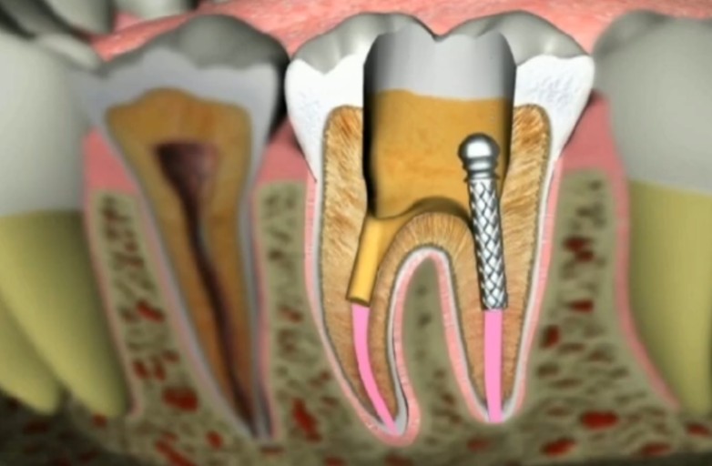 치근단절제술이 필요한 경우 - 일반 신경치료 후 증상이 지속되거나 재발한 경우