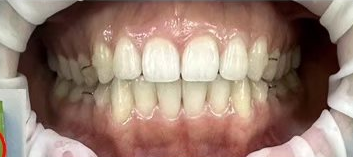 드림연합치과는 안전성이 검증된 고농도 불소 용액을 사용하며, 환자분의 연령과 구강 상태를 고려하여 적절한 농도와 방법으로 불소도포를 시행 도포 전