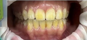 드림연합치과는 안전성이 검증된 고농도 불소 용액을 사용하며, 환자분의 연령과 구강 상태를 고려하여 적절한 농도와 방법으로 불소도포를 시행 도포 후