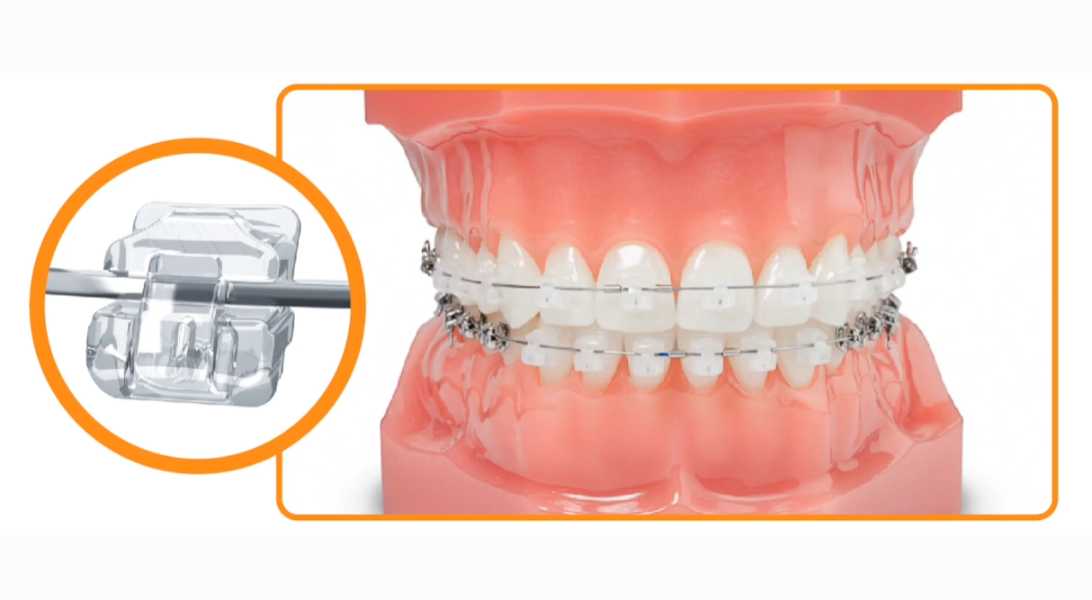 클리피씨 교정 브라켓 작동 원리: 자가 결찰 방식 상세 설명"