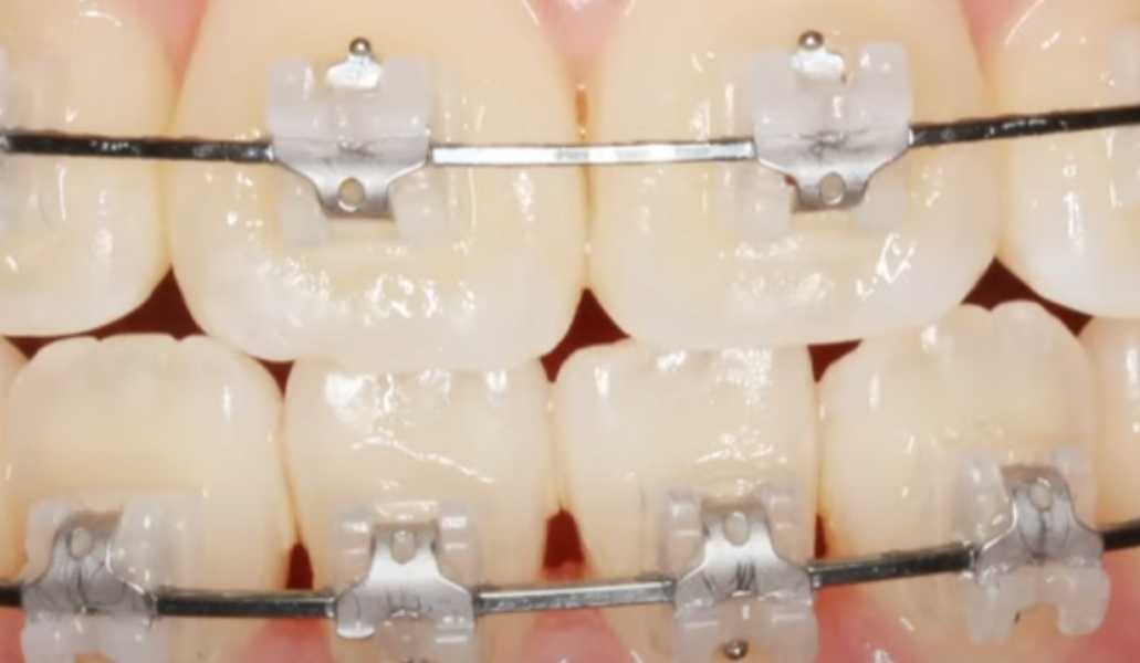 울산 교정 치과 드림연합치과에서 알려드리는 교정 장치 종류 (Types of Braces)클리피씨 교정: 자가 결찰 방식, 마찰력 적어 통증 감소, 치료 기간 단축 효과, 비용 높음