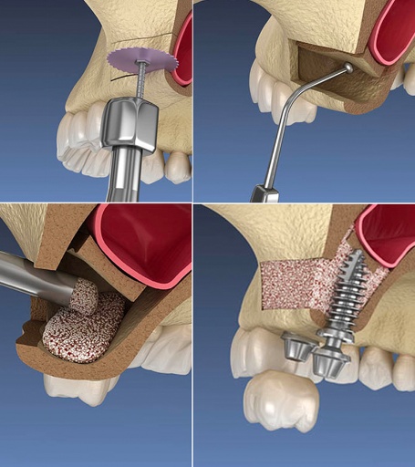 상악동 거상술 (Sinus lift) 상악 구치부의 골량이 부족할 때 사용하는 방법