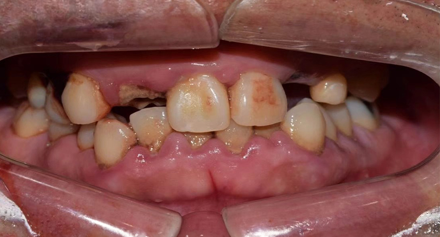 드림연합치과에서 임플란트 치료 전의 환자 사진입니다. 치열이 고르지않고 이빨이 군데군데 빠져있으며, 고난이도로 보이는 치열입니다. 임플란트 치료는 단순한 치아 대체를 넘어 여러분의 삶의 질을 향상시키는 과정입니다. 드림연합치과에서는 평균 3-6개월에 걸쳐 진행되는 임플란트 치료를 통해 자연스러운 미소와 편안한 저작 기능을 되찾아드립니다. 우리의 전문적이고 체계적인 접근 방식으로 임플란트 성공률을 극대화하고, 환자 만족도를 높이고 있습니다
