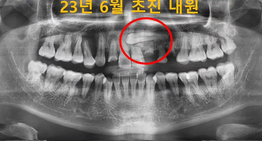 드림연합치과에서 임플란트 치료 전의 환자 사진입니다. 치열이 고르지않고 이빨이 군데군데 빠져있으며, 고난이도로 보이는 치열입니다. 임플란트 치료는 단순한 치아 대체를 넘어 여러분의 삶의 질을 향상시키는 과정입니다. 드림연합치과에서는 평균 3-6개월에 걸쳐 진행되는 임플란트 치료를 통해 자연스러운 미소와 편안한 저작 기능을 되찾아드립니다. 우리의 전문적이고 체계적인 접근 방식으로 임플란트 성공률을 극대화하고, 환자 만족도를 높이고 있습니다