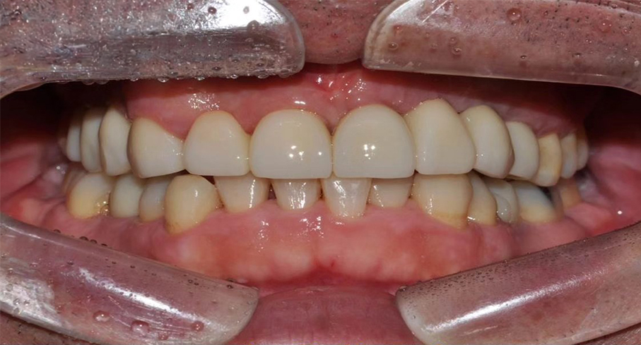 드림연합치과에서 임플란트 치료 후 치열이 고르게 정렬되고 임플란트가 아주 잘 된 모습니다. 이제 관리만 잘 하면 오랜 기간동안 임플란트를 자연치아처럼 유지할 수 있습니다. 드림연합치과에서 임플란트 치료 전의 환자 사진입니다. 치열이 고르지않고 이빨이 군데군데 빠져있으며, 고난이도로 보이는 치열입니다. 임플란트 치료는 단순한 치아 대체를 넘어 여러분의 삶의 질을 향상시키는 과정입니다. 드림연합치과에서는 평균 3-6개월에 걸쳐 진행되는 임플란트 치료를 통해 자연스러운 미소와 편안한 저작 기능을 되찾아드립니다. 우리의 전문적이고 체계적인 접근 방식으로 임플란트 성공률을 극대화하고, 환자 만족도를 높이고 있습니다