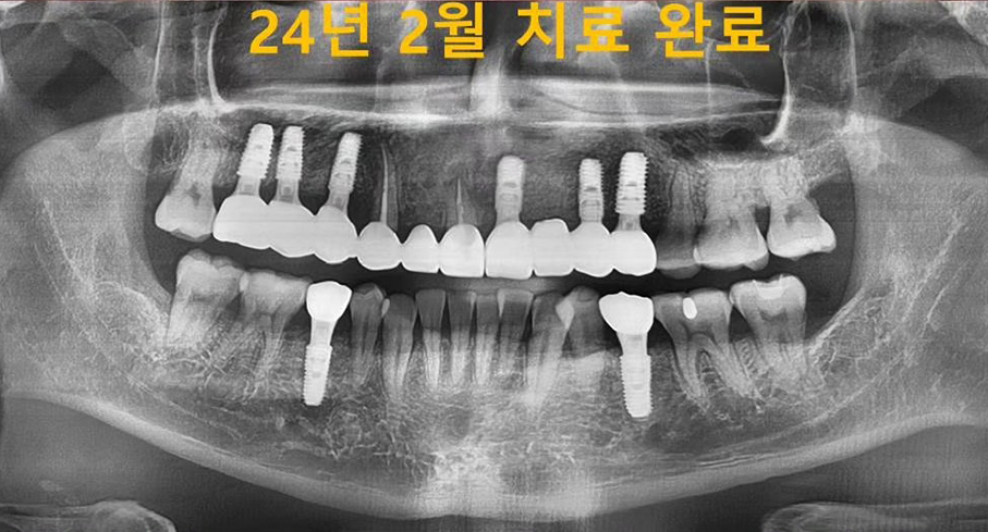 드림연합치과에서 임플란트 치료 후 치열이 고르게 정렬되고 임플란트가 아주 잘 된 모습니다. 이제 관리만 잘 하면 오랜 기간동안 임플란트를 자연치아처럼 유지할 수 있습니다. 드림연합치과에서 임플란트 치료 전의 환자 사진입니다. 치열이 고르지않고 이빨이 군데군데 빠져있으며, 고난이도로 보이는 치열입니다. 임플란트 치료는 단순한 치아 대체를 넘어 여러분의 삶의 질을 향상시키는 과정입니다. 드림연합치과에서는 평균 3-6개월에 걸쳐 진행되는 임플란트 치료를 통해 자연스러운 미소와 편안한 저작 기능을 되찾아드립니다. 우리의 전문적이고 체계적인 접근 방식으로 임플란트 성공률을 극대화하고, 환자 만족도를 높이고 있습니다 드림연합치과에서 임플란트 치료 후 치열이 고르게 정렬되고 임플란트가 아주 잘 된 모습니다. 이제 관리만 잘 하면 오랜 기간동안 임플란트를 자연치아처럼 유지할 수 있습니다. 드림연합치과에서 임플란트 치료 전의 환자 사진입니다. 치열이 고르지않고 이빨이 군데군데 빠져있으며, 고난이도로 보이는 치열입니다. 임플란트 치료는 단순한 치아 대체를 넘어 여러분의 삶의 질을 향상시키는 과정입니다. 드림연합치과에서는 평균 3-6개월에 걸쳐 진행되는 임플란트 치료를 통해 자연스러운 미소와 편안한 저작 기능을 되찾아드립니다. 우리의 전문적이고 체계적인 접근 방식으로 임플란트 성공률을 극대화하고, 환자 만족도를 높이고 있습니다