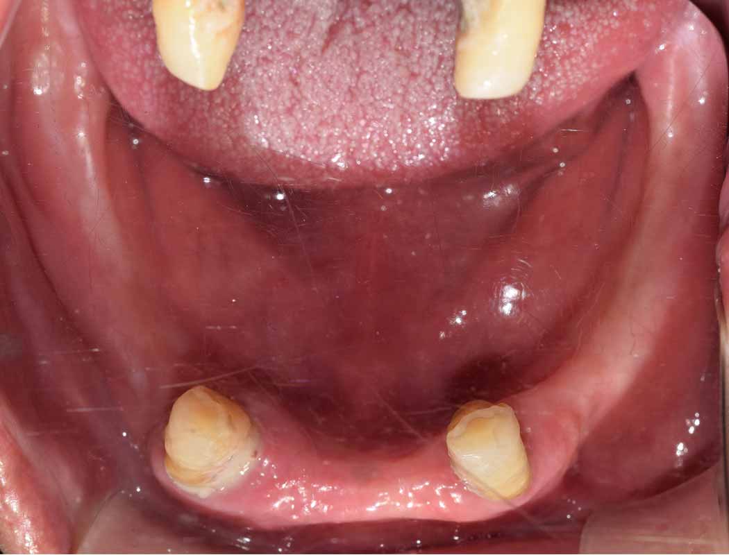 이러한 복잡한 케이스에 대해, 드림연합치과의 전문의들은 대학병원에서 축적한 풍부한 임상 경험과 최신 임플란트 기술을 결합하여 최적의 솔루션을 제시합니다. 우리의 접근 방식은 단순한 치아 대체를 넘어, 환자의 전반적인 구강 건강과 삶의 질 향상을 목표로 합니다 드림연합치과 실제 전체임플란트사례 전사진