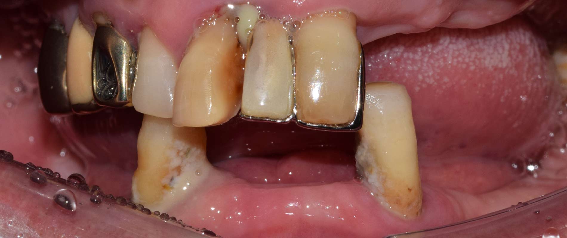 울산 임플란트 잘하는 울산 치과에 환자분의 상담에서 잔존치아가 많지 않고 잔존한 치아들도 많이 흔들려 드림연합치과 변성훈 원장님께서 검진 후 전악 임플란트로 진행하시기로 한 환자 전 사진