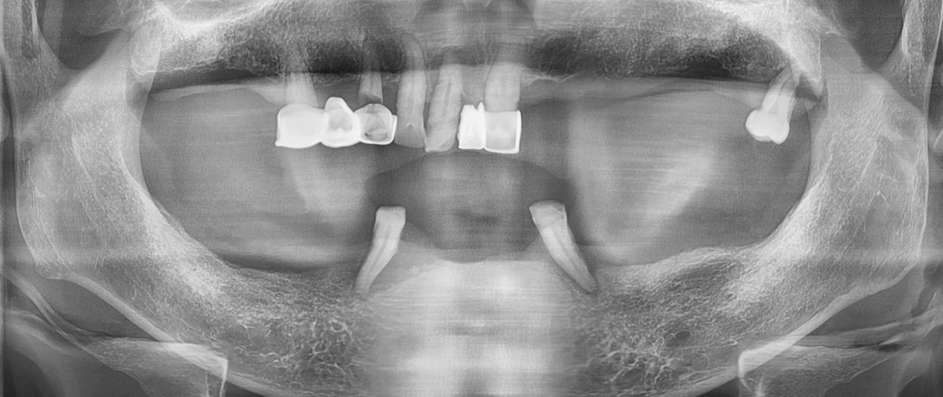 울산 임플란트 잘하는 울산 치과에 환자분의 상담에서 잔존치아가 많지 않고 잔존한 치아들도 많이 흔들려 드림연합치과 변성훈 원장님께서 검진 후 전악 임플란트로 진행하시기로 한 심각한 환자 전 사진 CT 사진