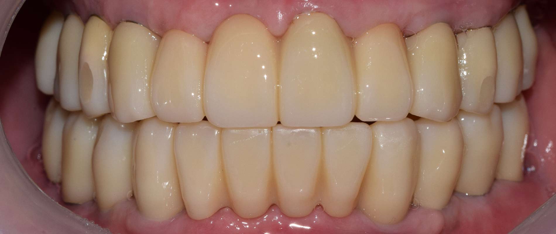 울산 임플란트 잘하는 울산 치과에 환자분의 상담에서 잔존치아가 많지 않고 잔존한 치아들도 많이 흔들려 드림연합치과 변성훈 원장님께서 검진 후 전악 임플란트로 진행하시기로 한 환자 후 사진