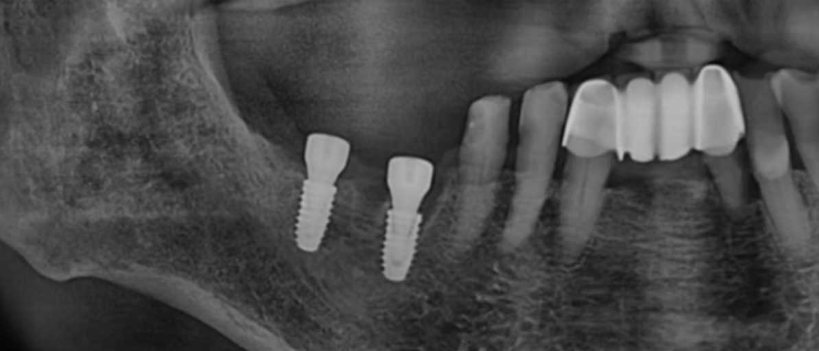 4. 임플란트 보험 신청 방법 임플란트 보험 신청 절차는 간단합니다. 치과 방문 후, 치과 의사의 진단을 받아 보험 적용 여부를 확인합니다. 치과에서 보험 신청을 대행해 국민건강보험공단에 신청서를 제출합니다. 신청이 승인되면, 임플란트 시술을 진행할 수 있습니다​