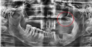 부비동 막 리프트 또는 상악동 거상술(부비동 증강술)은 그 공기 공간의 바닥을 채우기 위해 뼈를 추가하는 것을 포함하며, 본질적으로 부비동 강 바닥을 올립니다. 왜 이미 거기에 충분한 뼈가 없을까요? 어떤 사람들에게는 단순히 부비동 강이 얼마나 크고 모양이냐의 문제일 뿐입니다. 다른 경우에는 실제로 그 부위에서 뼈가 손실되었습니다. 예를 들어, 치아가 오랫동안 빠졌다면 치아를 둘러싸고 있던 뼈가 악화되기 시작했을 수 있습니다. 일반적으로 뼈는 강하게 유지되기 위해 자극이 필요합니다. 턱뼈의 경우 그 자극은 치아에서 나옵니다. 치아가 빠지면 뼈가 자극을 잃고 신체는 그 부위에서 새로운 뼈 세포를 만드는 것을 멈춥니다. 이로 인해 뼈의 양과 밀도가 감소합니다. 또한 치아가 빠진 것이 치주(잇몸) 질환 때문이라면 치아를 지지하는 뼈가 질병의 결과로 감소했을 수 있습니다. 뼈가 부족한 이유가 무엇이든 부비동 막 리프트는 필요한 곳에 더 많은 뼈를 생성할 수 있습니다. 이것을 치과에서는 상악동 거상술 임플란트라고 하며, 드림연합치과는 상악동 거상술에 풍부한 경험이 있는 전문의들이 있습니다.