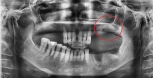 부비동 막 리프트 또는 상악동 거상술(부비동 증강술)은 그 공기 공간의 바닥을 채우기 위해 뼈를 추가하는 것을 포함하며, 본질적으로 부비동 강 바닥을 올립니다. 왜 이미 거기에 충분한 뼈가 없을까요? 어떤 사람들에게는 단순히 부비동 강이 얼마나 크고 모양이냐의 문제일 뿐입니다. 다른 경우에는 실제로 그 부위에서 뼈가 손실되었습니다. 예를 들어, 치아가 오랫동안 빠졌다면 치아를 둘러싸고 있던 뼈가 악화되기 시작했을 수 있습니다. 일반적으로 뼈는 강하게 유지되기 위해 자극이 필요합니다. 턱뼈의 경우 그 자극은 치아에서 나옵니다. 치아가 빠지면 뼈가 자극을 잃고 신체는 그 부위에서 새로운 뼈 세포를 만드는 것을 멈춥니다. 이로 인해 뼈의 양과 밀도가 감소합니다. 또한 치아가 빠진 것이 치주(잇몸) 질환 때문이라면 치아를 지지하는 뼈가 질병의 결과로 감소했을 수 있습니다. 뼈가 부족한 이유가 무엇이든 부비동 막 리프트는 필요한 곳에 더 많은 뼈를 생성할 수 있습니다. 이것을 치과에서는 상악동 거상술 임플란트라고 하며, 드림연합치과는 상악동 거상술에 풍부한 경험이 있는 전문의들이 있습니다.