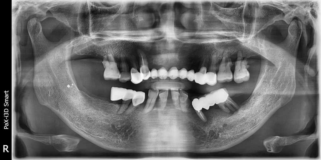 무치악 임플란트 전체 치아를 상실한 경우 고정성 전체 임플란트를 통해 치아를 복원하는 치료방법입니다. 정확한 위치에 임플란트를 심는 것 뿐만 아니라 턱 관절과 근육, 얼굴형태와 조화를 만드는 것이 중요합니다. 치아를 상실하기 전의 건강하고 아름다운 모습을 되찾을 수 있습니다.