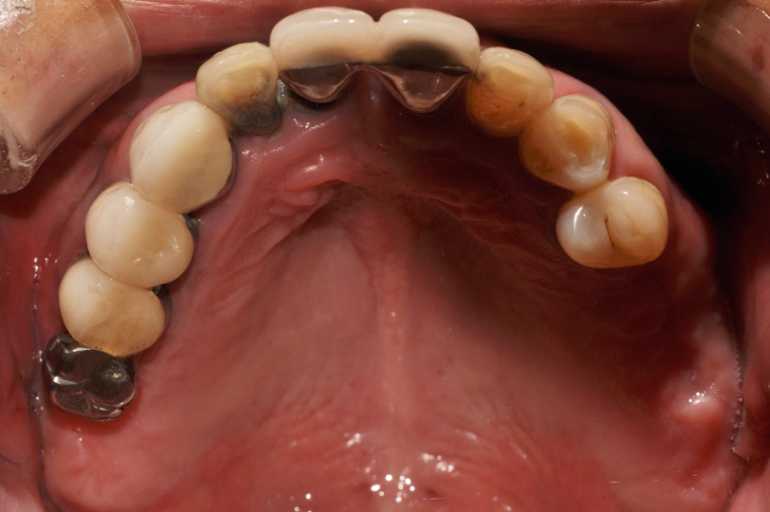 울산치과 드림연합치과 임플란트 실제 사례 무치악 임플란트 무치악 임플란트 추천대상 치아가 없으나 자연치아 기능을 원하시는 분 오랜 틀니 사용이 불편하신 분 치아 때문에 발음이 부정확한 경우 얼굴 형태 변화가 오시는 분