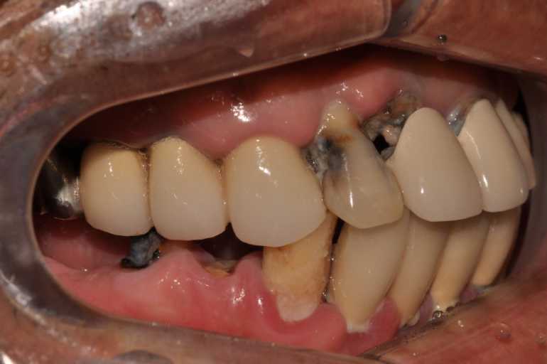 울산치과 드림연합치과 임플란트 실제 사례 무치악 임플란트 무치악 임플란트 추천대상 치아가 없으나 자연치아 기능을 원하시는 분 오랜 틀니 사용이 불편하신 분 치아 때문에 발음이 부정확한 경우 얼굴 형태 변화가 오시는 분