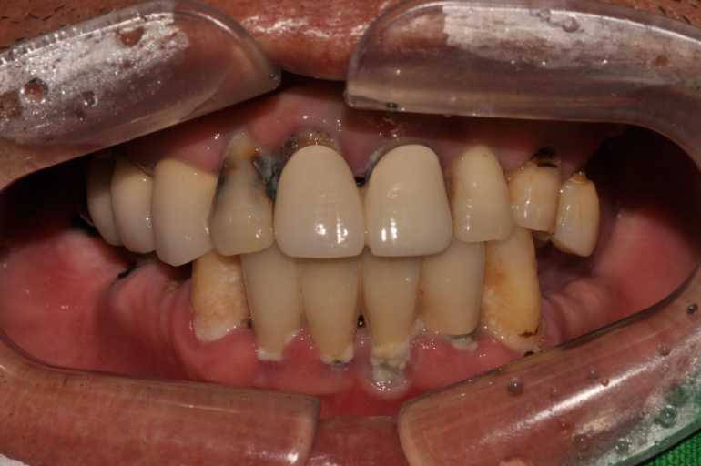 울산치과 드림연합치과 임플란트 실제 사례 무치악 임플란트 무치악 임플란트 추천대상 치아가 없으나 자연치아 기능을 원하시는 분 오랜 틀니 사용이 불편하신 분 치아 때문에 발음이 부정확한 경우 얼굴 형태 변화가 오시는 분