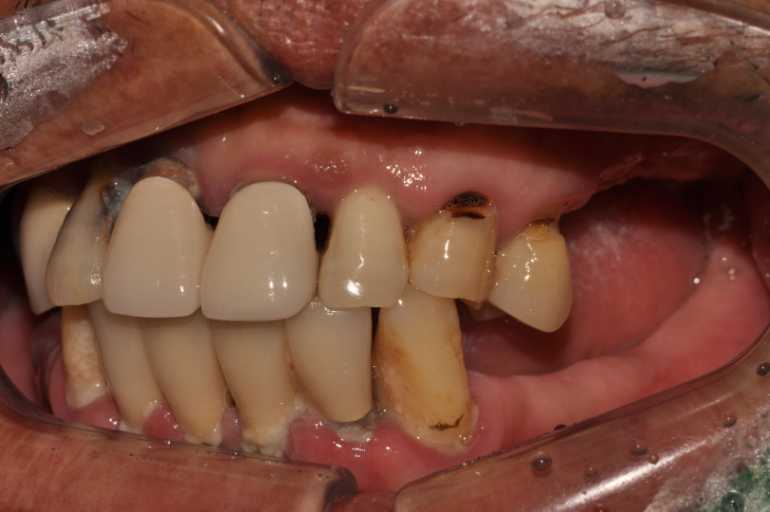 울산치과 드림연합치과 임플란트 실제 사례 무치악 임플란트 무치악 임플란트 추천대상 치아가 없으나 자연치아 기능을 원하시는 분 오랜 틀니 사용이 불편하신 분 치아 때문에 발음이 부정확한 경우 얼굴 형태 변화가 오시는 분