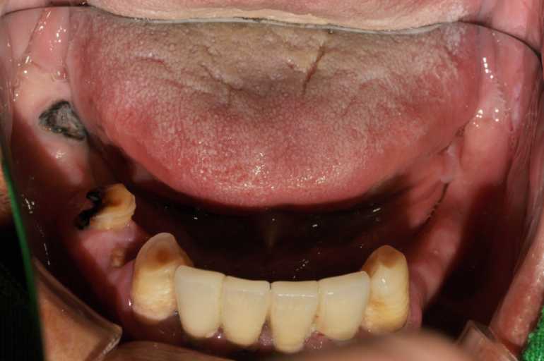 울산치과 드림연합치과 임플란트 실제 사례 무치악 임플란트 무치악 임플란트 추천대상 치아가 없으나 자연치아 기능을 원하시는 분 오랜 틀니 사용이 불편하신 분 치아 때문에 발음이 부정확한 경우 얼굴 형태 변화가 오시는 분