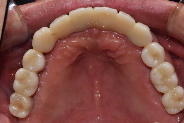 울산치과 드림연합치과 임플란트 실제 사례 무치악 임플란트 무치악 임플란트 추천대상 치아가 없으나 자연치아 기능을 원하시는 분 오랜 틀니 사용이 불편하신 분 치아 때문에 발음이 부정확한 경우 얼굴 형태 변화가 오시는 분