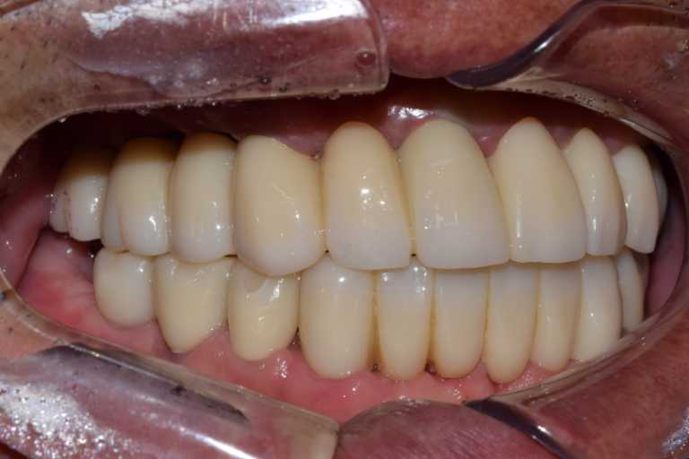 울산치과 드림연합치과 임플란트 실제 사례 무치악 임플란트 무치악 임플란트 추천대상 치아가 없으나 자연치아 기능을 원하시는 분 오랜 틀니 사용이 불편하신 분 치아 때문에 발음이 부정확한 경우 얼굴 형태 변화가 오시는 분