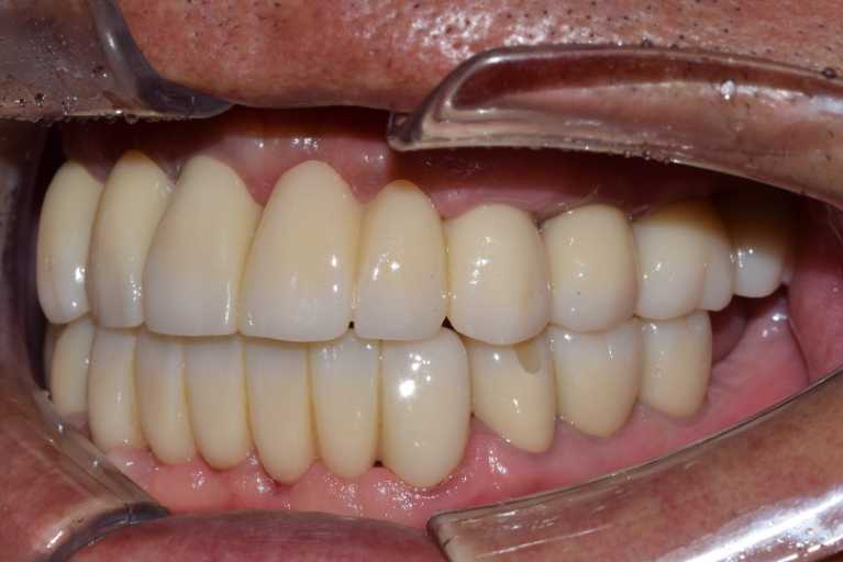 울산치과 드림연합치과 임플란트 실제 사례 무치악 임플란트 무치악 임플란트 추천대상 치아가 없으나 자연치아 기능을 원하시는 분 오랜 틀니 사용이 불편하신 분 치아 때문에 발음이 부정확한 경우 얼굴 형태 변화가 오시는 분