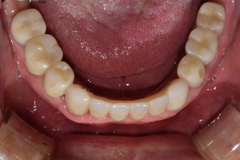 울산치과 드림연합치과 임플란트 실제 사례 무치악 임플란트 무치악 임플란트 추천대상 치아가 없으나 자연치아 기능을 원하시는 분 오랜 틀니 사용이 불편하신 분 치아 때문에 발음이 부정확한 경우 얼굴 형태 변화가 오시는 분