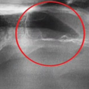 부비동 막 리프트 또는 상악동 거상술(부비동 증강술)은 그 공기 공간의 바닥을 채우기 위해 뼈를 추가하는 것을 포함하며, 본질적으로 부비동 강 바닥을 올립니다. 왜 이미 거기에 충분한 뼈가 없을까요? 어떤 사람들에게는 단순히 부비동 강이 얼마나 크고 모양이냐의 문제일 뿐입니다. 다른 경우에는 실제로 그 부위에서 뼈가 손실되었습니다. 예를 들어, 치아가 오랫동안 빠졌다면 치아를 둘러싸고 있던 뼈가 악화되기 시작했을 수 있습니다. 일반적으로 뼈는 강하게 유지되기 위해 자극이 필요합니다. 턱뼈의 경우 그 자극은 치아에서 나옵니다. 치아가 빠지면 뼈가 자극을 잃고 신체는 그 부위에서 새로운 뼈 세포를 만드는 것을 멈춥니다. 이로 인해 뼈의 양과 밀도가 감소합니다. 또한 치아가 빠진 것이 치주(잇몸) 질환 때문이라면 치아를 지지하는 뼈가 질병의 결과로 감소했을 수 있습니다. 뼈가 부족한 이유가 무엇이든 부비동 막 리프트는 필요한 곳에 더 많은 뼈를 생성할 수 있습니다. 이것을 치과에서는 상악동 거상술 임플란트라고 하며, 드림연합치과는 상악동 거상술에 풍부한 경험이 있는 전문의들이 있습니다.