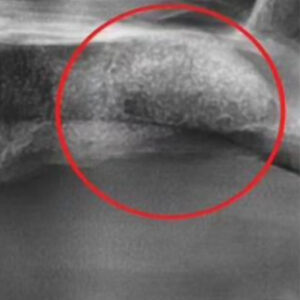 부비동 막 리프트 또는 상악동 거상술(부비동 증강술)은 그 공기 공간의 바닥을 채우기 위해 뼈를 추가하는 것을 포함하며, 본질적으로 부비동 강 바닥을 올립니다. 왜 이미 거기에 충분한 뼈가 없을까요? 어떤 사람들에게는 단순히 부비동 강이 얼마나 크고 모양이냐의 문제일 뿐입니다. 다른 경우에는 실제로 그 부위에서 뼈가 손실되었습니다. 예를 들어, 치아가 오랫동안 빠졌다면 치아를 둘러싸고 있던 뼈가 악화되기 시작했을 수 있습니다. 일반적으로 뼈는 강하게 유지되기 위해 자극이 필요합니다. 턱뼈의 경우 그 자극은 치아에서 나옵니다. 치아가 빠지면 뼈가 자극을 잃고 신체는 그 부위에서 새로운 뼈 세포를 만드는 것을 멈춥니다. 이로 인해 뼈의 양과 밀도가 감소합니다. 또한 치아가 빠진 것이 치주(잇몸) 질환 때문이라면 치아를 지지하는 뼈가 질병의 결과로 감소했을 수 있습니다. 뼈가 부족한 이유가 무엇이든 부비동 막 리프트는 필요한 곳에 더 많은 뼈를 생성할 수 있습니다. 이것을 치과에서는 상악동 거상술 임플란트라고 하며, 드림연합치과는 상악동 거상술에 풍부한 경험이 있는 전문의들이 있습니다.