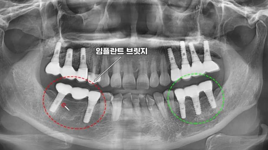 임플란트 브릿지는 여러 개의 치아가 연속적으로 상실되었을 때, 임플란트를 기둥 삼아 인공치아를 연결하는 보철물입니다. 자연치아를 최대한 보존하면서 튼튼하고 안정적인 치아 연결을 가능하게 합니다.