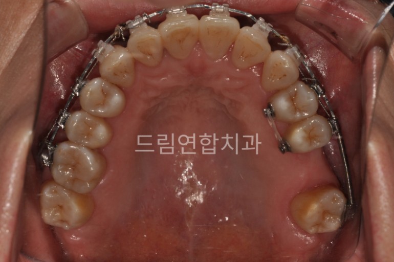 울산 교정 치과 추천 드림연합치과 보철 전 교정 항목별 구성 임플란트 교정 (Pre-Implant Orthodontics) 문제: 치아 상실 후 주변 치아가 기울거나 이동해 임플란트 식립 공간이 부족함. 영향: 임플란트 식립이 어려워지고 보철물의 안정성 저하. 치료 방법: 교정 장치를 통해 기울어진 치아를 제자리로 이동. 임플란트 식립 공간을 확보하고 교합을 개선. 예시 사례: 쓰러진 어금니를 교정해 임플란트 식립 성공 및 드림연합치과 의료진 협진 사례. 환자 실제 사례 교정 중.