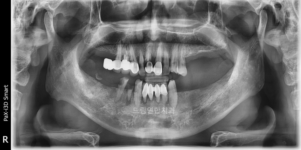 임플란트 식립 전 X-ray 이미지 – 무치악 상태 진단을 위한 정밀 검사