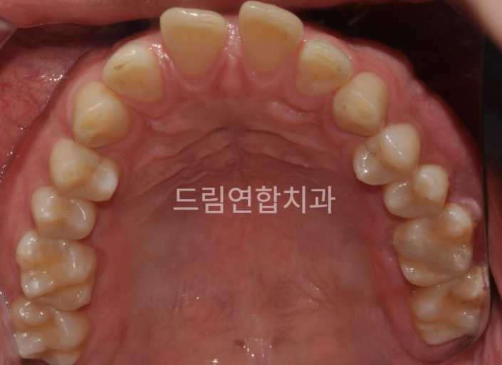 울산 교정 치과 추천 드림연합치과 유형별 교정 치아 사이 공간 부족 (Space Correction) 문제: 치아 간격이 지나치게 좁거나 공간이 부족해 맹출이 어려움. 치료: 공간 유지 장치 및 악궁 확장 장치 사용. 결과: 치아 맹출 문제 해결로 건강한 치열 유지.