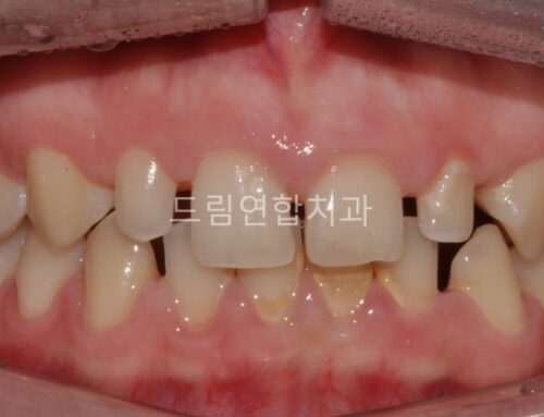 왜소치 | 작고 뾰족한 치아, 라미네이트로 해결? (울산 드림연합치과)